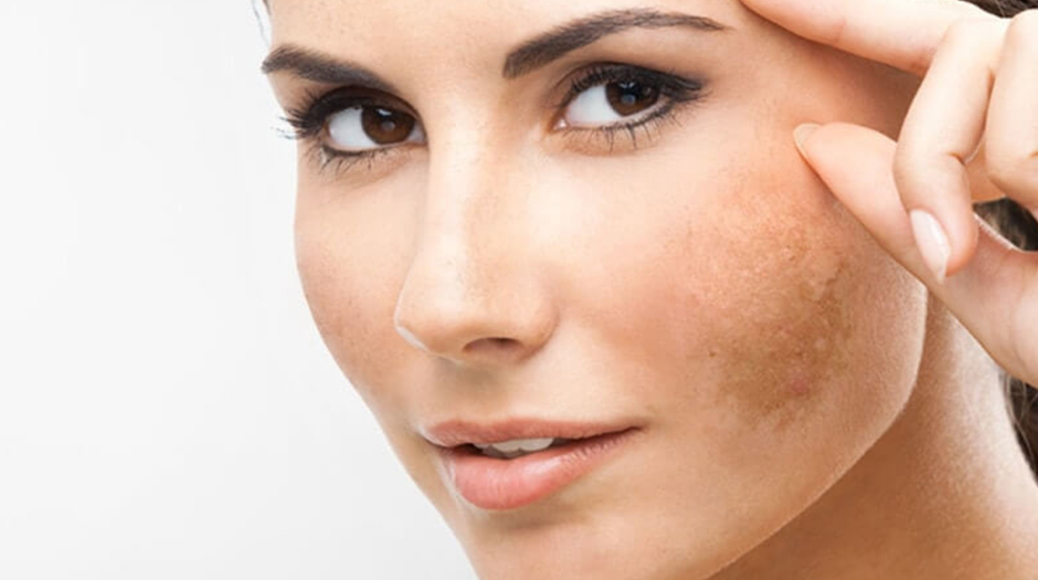 Freckles, Skin Discoloration, and Sun Exposure