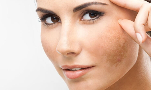 Freckles, Skin Discoloration, and Sun Exposure